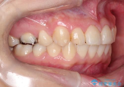 【ワイヤー矯正】前歯が出てるのをなおしたい。の治療後