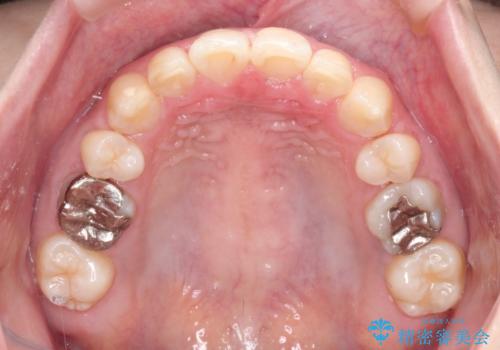 【ワイヤー矯正】前歯が出てるのをなおしたい。の治療後
