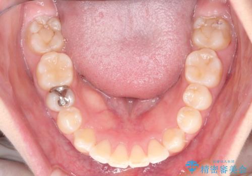 【ワイヤー矯正】前歯が出てるのをなおしたい。の治療後