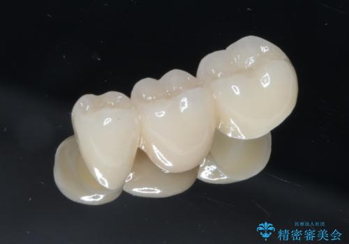 奥歯で噛めるようになりたい。オールセラミッククラウンブリッジ