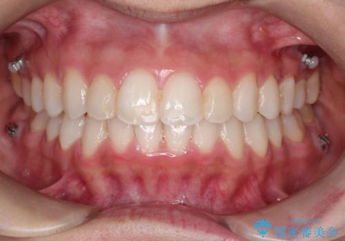 【非抜歯矯正】できる限り前歯を引っ込めたい