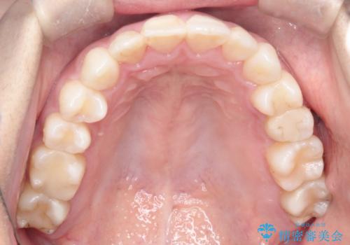 【非抜歯矯正】できる限り前歯を引っ込めたいの治療後