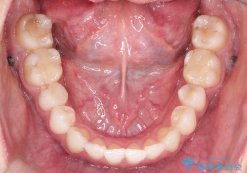 【非抜歯矯正】できる限り前歯を引っ込めたいの治療後