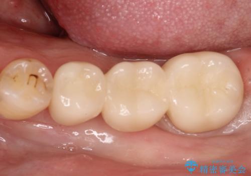 奥歯で噛めるようになりたい。オールセラミッククラウンブリッジの治療後