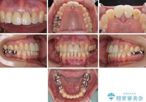 部分矯正とセラミック 前歯の審美治療の治療後