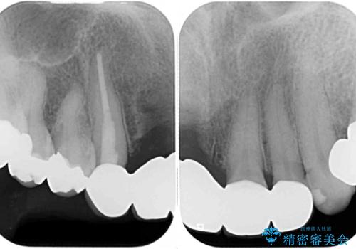 汚い仮歯で困っている 前歯のオールセラミックブリッジの治療後