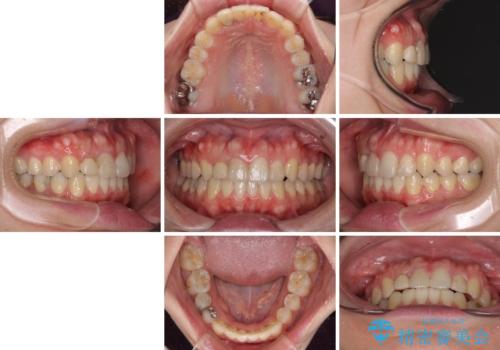 狭い上顎骨を拡大 インビザラインによる非抜歯矯正の治療後