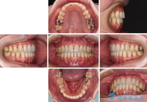 八重歯のインビザライン矯正治療の治療後