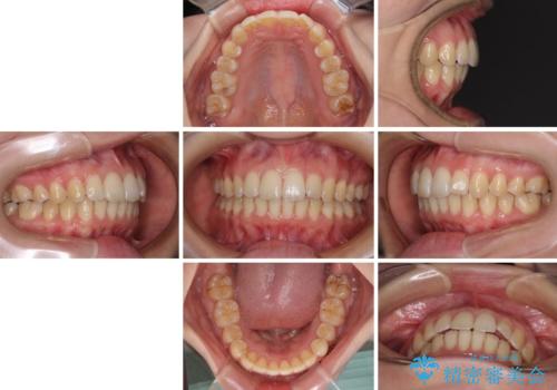 前歯のデコボコを解消 インビザラインによる矯正治療の治療後