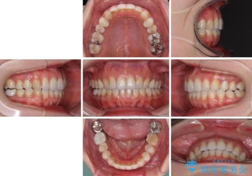 総合歯科治療　矯正治療と失活歯のセラミック補綴治療の治療後