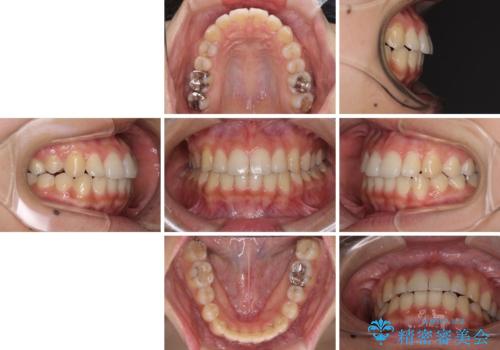 前歯の突出感とデコボコ インビザラインで改善の治療後