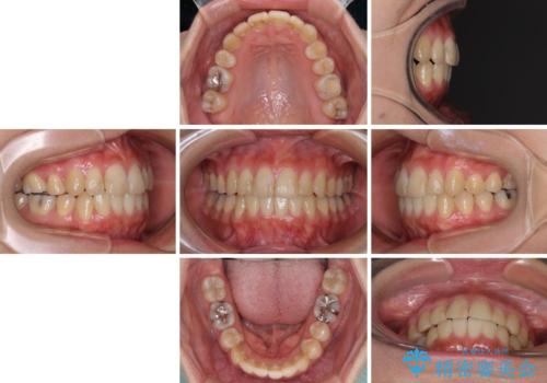 上下の八重歯を治したい インビザラインと補助装置を用いた抜歯治療の治療後