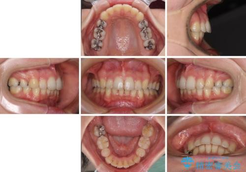 閉じにくい口元 前歯を引っ込める抜歯矯正の治療後