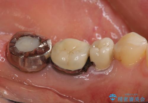 強い咬合力に対抗するメタルボンド補綴の治療前