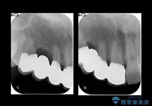前歯の虫歯 とりあえずつけていた歯がとれたの治療後