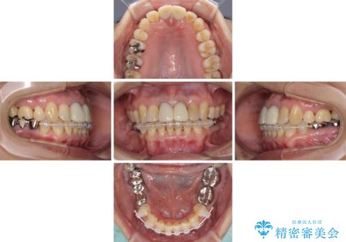 部分矯正とセラミック 前歯の審美治療の治療中