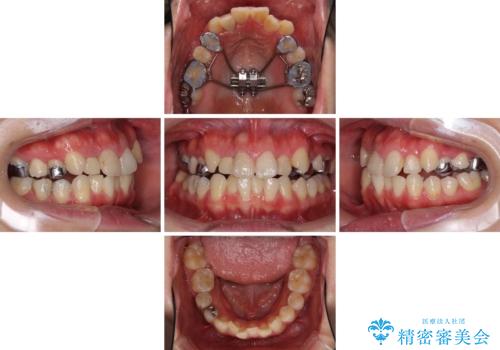 狭い上顎骨を拡大 インビザラインによる非抜歯矯正の治療中