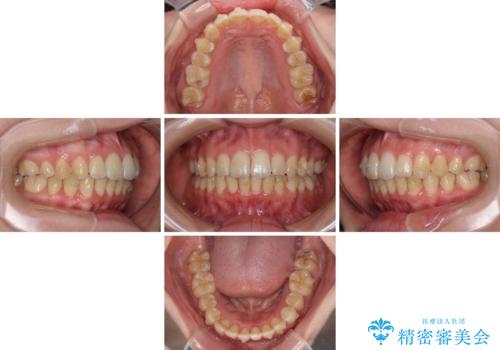 前歯のデコボコを解消 インビザラインによる矯正治療の治療中