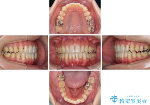八重歯のインビザライン矯正治療の治療中