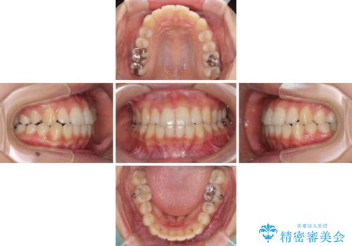 前歯の突出感とデコボコ インビザラインで改善の治療中