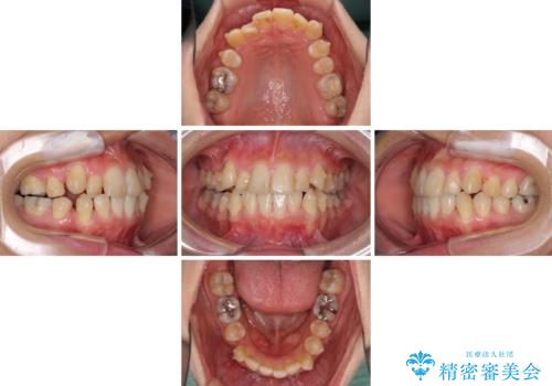 上下の八重歯を治したい インビザラインと補助装置を用いた抜歯治療の治療中