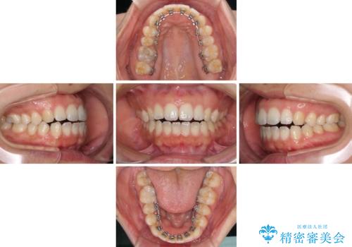 全く目立たないワイヤー矯正 上下リンガル矯正の治療中