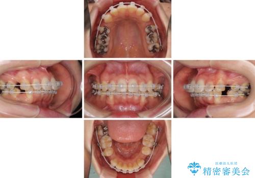 閉じにくい口元 前歯を引っ込める抜歯矯正の治療中