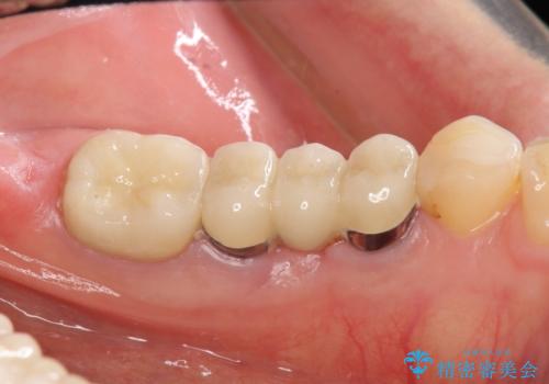 強い咬合力に対抗するメタルボンド補綴の治療後