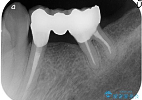 金属のかぶせ物をセラミックへ 根管治療からの再治療の治療後
