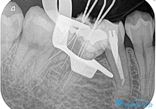 【湾曲根管】奥歯がズキズキ痛い の治療前