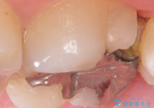 食べ物が詰まる　親知らずが原因の虫歯再発の症例 治療前