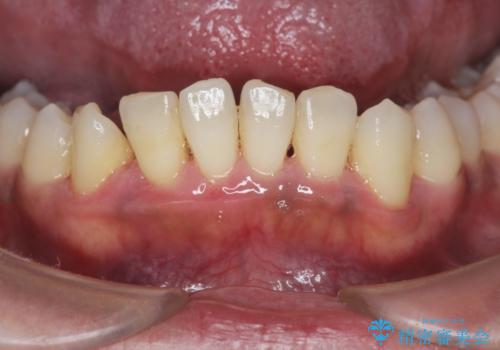 [ 非外科・歯石除去 ]  歯周初期治療による歯肉状態の改善の治療後