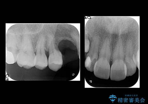 前歯の虫歯 とりあえずつけていた歯がとれたの治療前