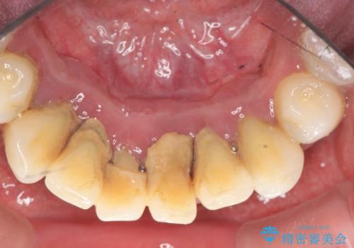 [ 非外科・歯石除去 ]  歯周初期治療による歯肉状態の改善の治療前