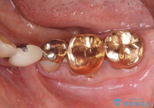 [セラミック治療]  金属色の目立つ口腔内を改善したいの治療前