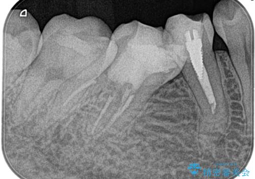 【湾曲根管】奥歯がズキズキ痛い の治療後