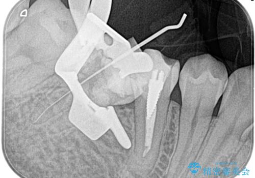 【湾曲根管】奥歯がズキズキ痛い の治療中