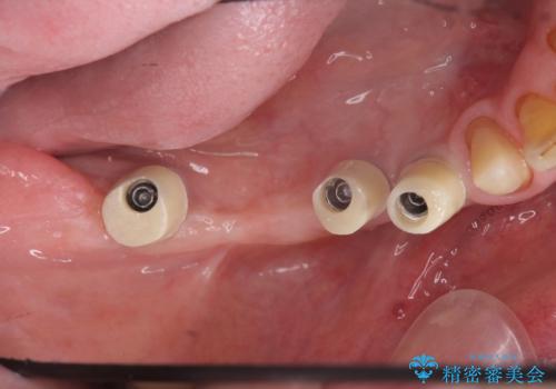 奥歯のインプラント治療の治療中
