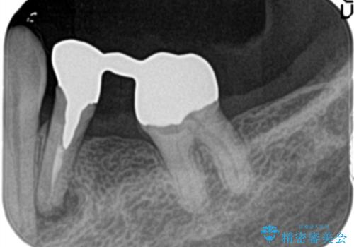 金属のかぶせ物をセラミックへ 根管治療からの再治療の治療前