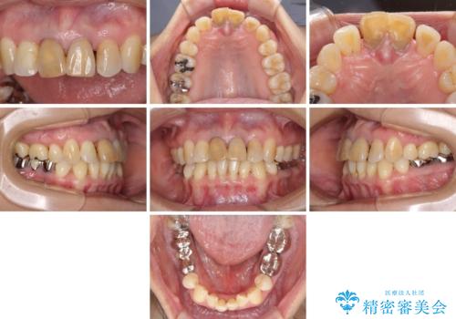 部分矯正とセラミック 前歯の審美治療の治療前