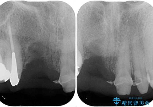 汚い仮歯で困っている 前歯のオールセラミックブリッジの治療前