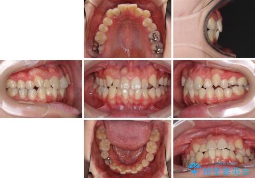 狭い上顎骨を拡大 インビザラインによる非抜歯矯正の治療前