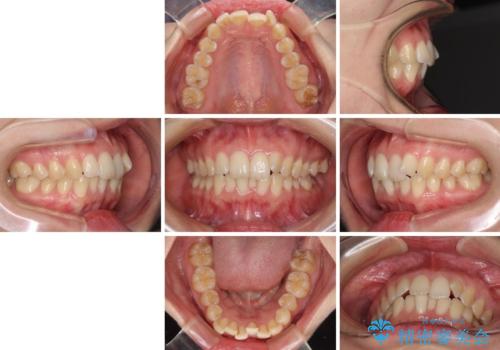 前歯のデコボコを解消 インビザラインによる矯正治療の治療前
