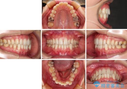 八重歯のインビザライン矯正治療の治療前