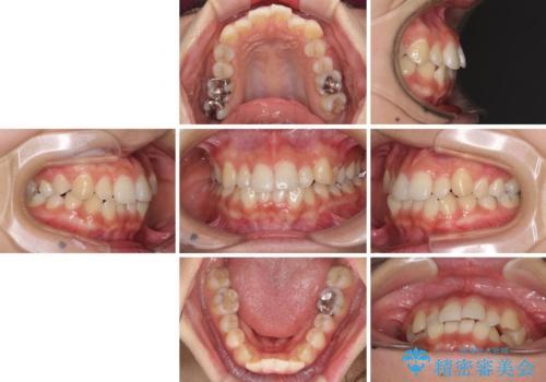 前歯の突出感とデコボコ インビザラインで改善の治療前