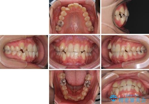 上下の八重歯を治したい　インビザラインと補助装置を用いた抜歯治療の治療前