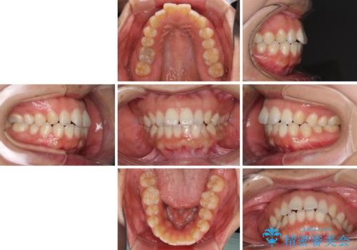 全く目立たないワイヤー矯正 上下リンガル矯正の治療前