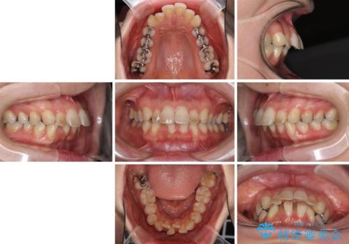 閉じにくい口元 前歯を引っ込める抜歯矯正の治療前