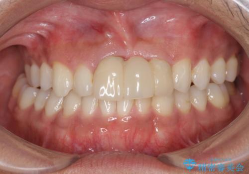 [前歯の歯根吸収]　前歯審美セラミックブリッジの製作の治療前