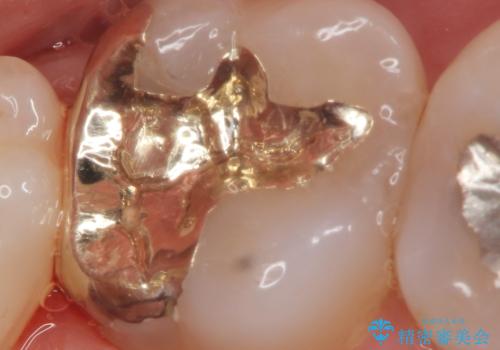食べ物が詰まる 親知らずが原因の虫歯再発の治療後